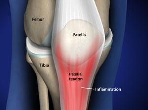 Patellar Tendonitis Treatment in IL | Kneecap Pain Solutions | Dr. Chams