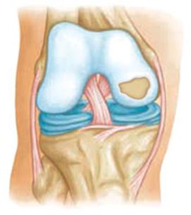 icd 10 code for osteochondritis dissecans right knee