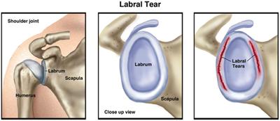 Shoulder Labrum Tear Surgery Near Me In Il | Dr. Chams