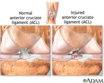 3 weeks post op ACL reconstruction and Lateral/Medial meniscus