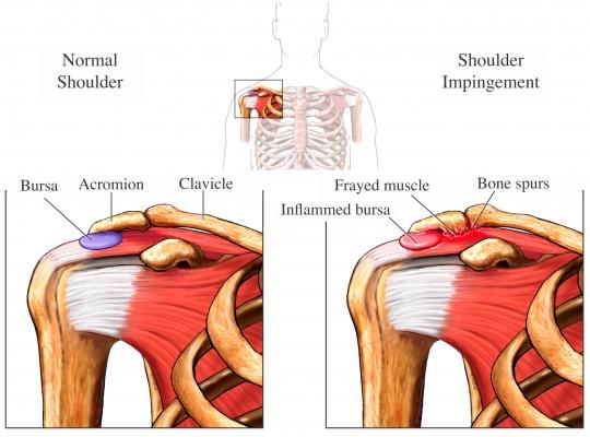 shoulder impingement diagnosis